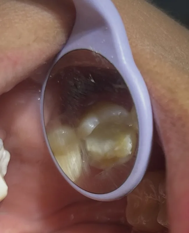 Antes de la incrustación de zirconia